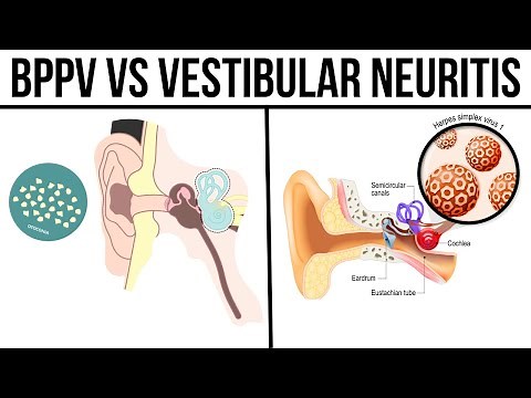 BPPV vs Vestibular Neuritis