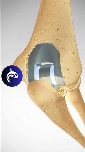 Total Elbow Replacement (TER) #anatomy #elbow #surgery