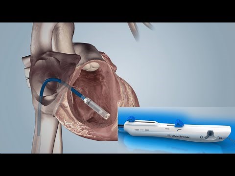 Leadless Pacemaker (PPM) Implantation