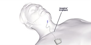 Alternative to CPAP machine for patients with sleep apnea showing promising results