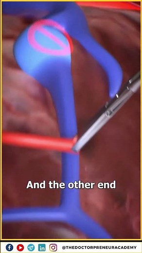 How Vein Grafts Save Lives: A Miracle in Cardiac Surgery! 🩺✨ #doctorlife