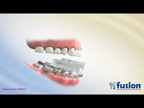 Anterior Crossbite Correction (Using RPE and Bite Block)