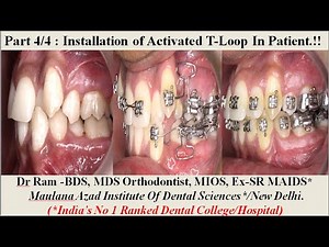T Loop Explained : Part 4/4 - T-Loop Installation Clinically. Problems Faced & Management @ Dr Ram