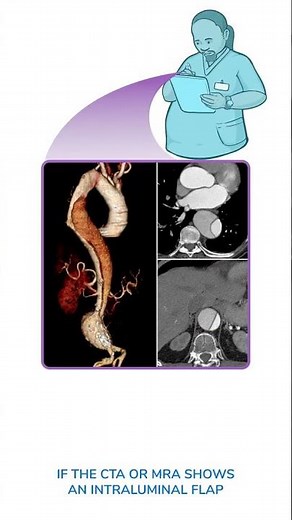 Diagnostics on Demand: Aortic dissection