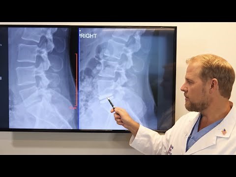 Lumbar Disc Replacement Surgery Explained By a Spine Surgeon