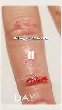 Wound Healing, Explained