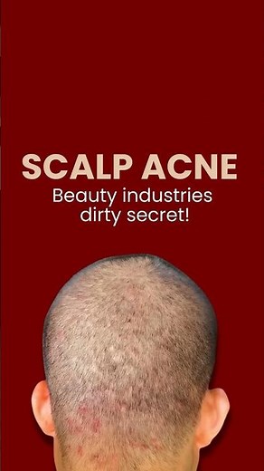 What Causes Itchy, Bumpy Scalp and How Do I Fix It?