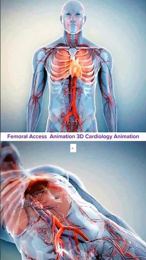 Femoral Access to Cardiac Chamber Cardiac Catheterization Procedure Animation3D Cardiology Animation