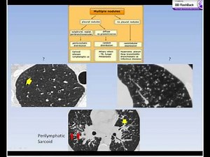 CT CHEST BASICS