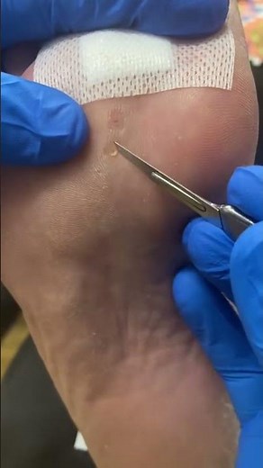 Eliminating Hard Corns with Expert Podiatrist Techniques in Australia | Effective Corn Removal