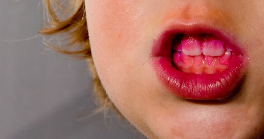 How to Use Plaque Disclosing Tablets to Show Dirty Teeth - Dentaly.org