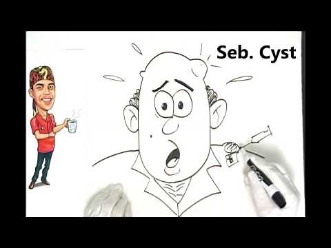 Sebaceous Cyst Explained Simply