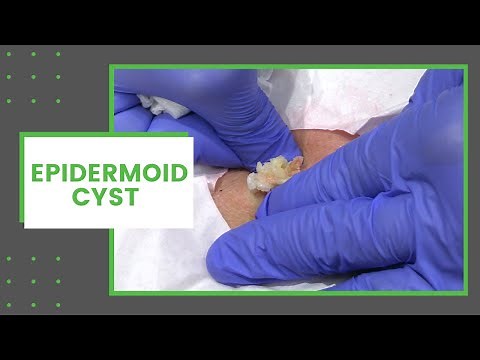 Epidermoid Cyst | Dr. Derm