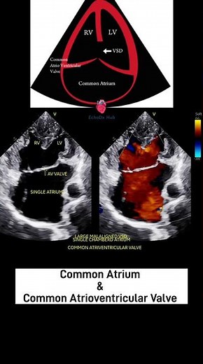 Common Atrium & Atrioventricular Canal Defect | 2D Echo Exploration #AVCanalDefect #CommonAtrium