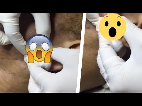 Enormous Zit Popping Caught on Camera
