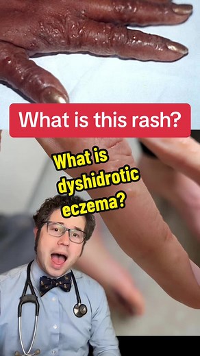 Dyshidrotic Eczema: Causes, Treatment, and More