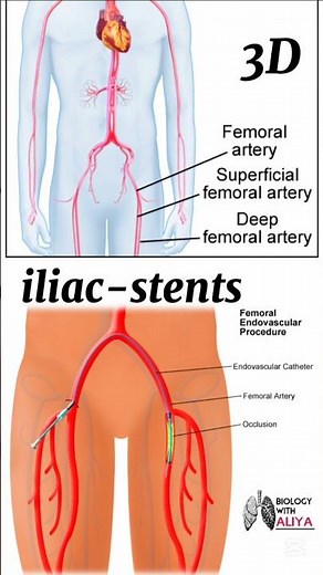 iliac stents #medical #animation #3d #short | BiologywithAliya