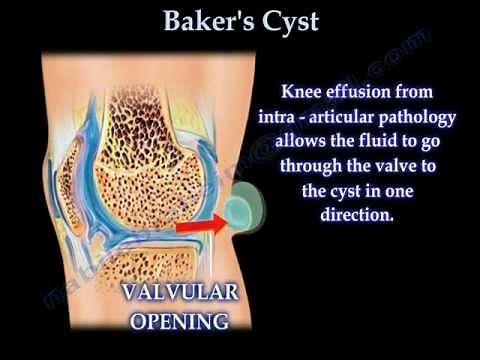 Baker's Cyst - Everything You Need To Know - Dr. Nabil Ebraheim