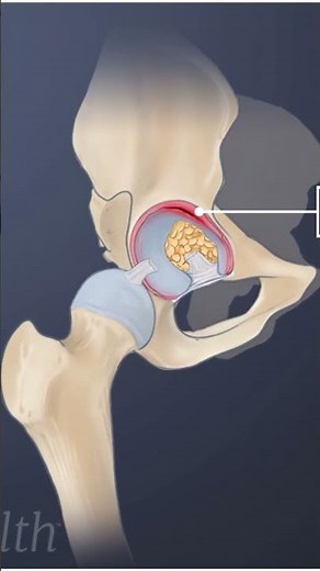What Causes a Hip Labral Tear?