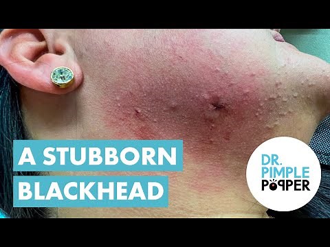 Dr Pimple Popper Helps With Blackhead Cyst
