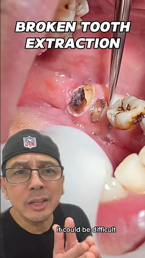 Broken Tooth & Root Tip Extraction (EASY) | In Office to Hands On Dental Training #shorts