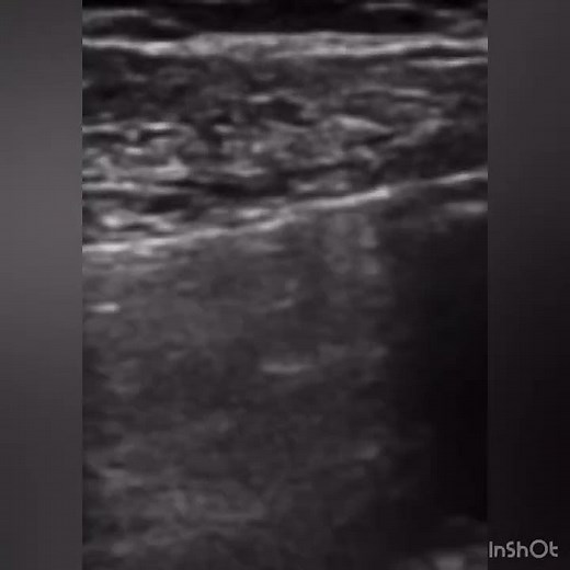 The Lung Sliding Sign: A POCUS Masterclass