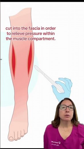 Compartment Syndrome: Medical Surgical SHORT | ‪@LevelUpRN‬