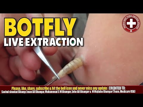 Live Botfly Larvae Extraction | Removal Process Caught on Camera.
