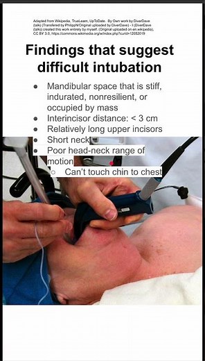Findings that suggest difficult intubation