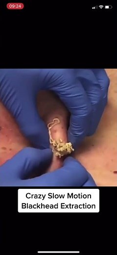 Pimple Popping | Acne Treatment | Blackhead Extraction
