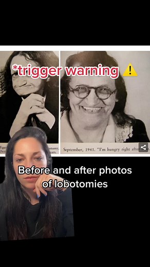 Disturbing Before and After Photos of Lobotomies