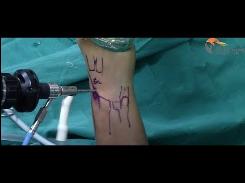 Arthroscpic TFCC Repair