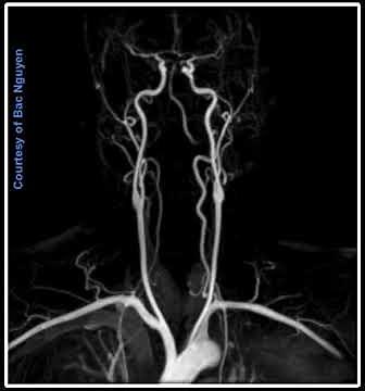 CE MRA - Carotids @ Siemens 1.5T Aera