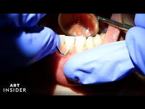 How Buildup Is Satisfyingly Removed From Teeth
