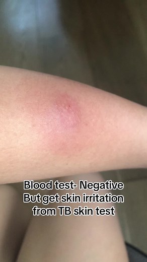 Negative Blood Test and Skin Irritation from TB Skin Test - What to Expect