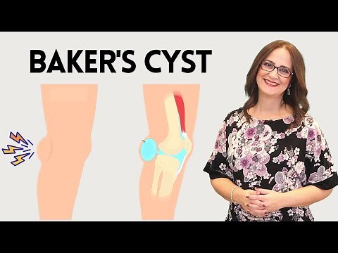 #128 Four Easy Ways to Treating a Baker's Cyst (#Popliteal #Cyst)