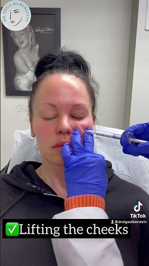 Full Face Using Radiesse Filler!