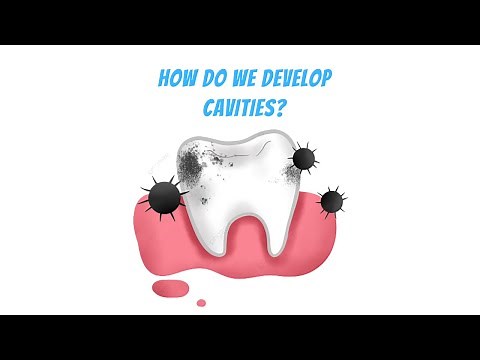How cavities develops from Tooth decay? (3D animation)
