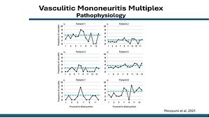 Mononeuritis Multiplex (MNM) Review