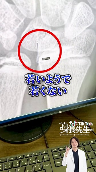 【C判定】11歳8ヶ月男の子 #身長先生の身長診断 晩熟の方必見‼️《晩熟の典型例》です！！ -————————————— 【最終身長】【伸び代】【治療可能か】 などを知りたい方へ 身長先生の身長診断では下記内容を総合的に分析し、より正確な【最終予測身長】が診断をしております。 ・骨端線（成長板）の状態 ・ホルモンや栄養バランスなどの採血結果 ・これまでの成長記録（成長シート） ・お子さまが“早熟タイプ”か“晩熟タイプ”か ・予測される最終身長 ・現在不足している栄養素や成長の阻害因子 現在、東京・大阪・愛知・群馬•埼玉で身長診断を受けられます。 ※東京以外の場合は検査協力機関さんで検査→当院で解析となります。 《通常価格¥55,000/部分モニター¥33,000》 ご希望の方はプロフィールTOP公式ラインから【身長先生の身長診断希望】と連絡ください📩 ⚠️推奨年齢5〜15歳 (※15歳以上でも受診は可能ですが、モニター適用外となります。) ※ 当院では主に《体質性低身長》に対する方への自費治療の身長治療を主におこなっております。 #身長先生 #東京神田整形外科クリニック #低身長 