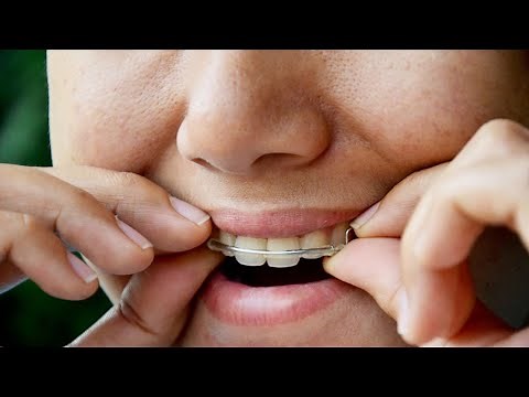 How Long Do I Have to Wear My Retainer and Why?