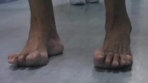 Pes Cavus and Coleman Block Test