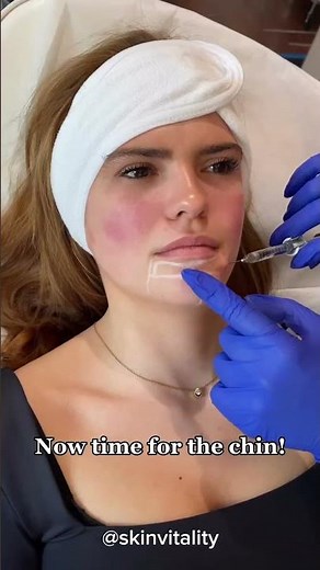 Chin and Cheek Filler: Cheek Filler Before and After - Chin Filler - Skin Vitality Oakville