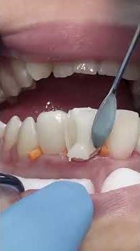 Composite veneer for anterior teeth #dentist