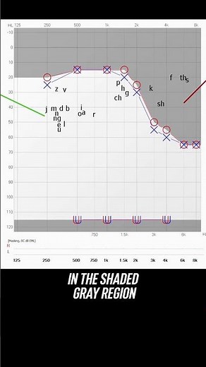 High-Pitch Hearing Loss Test Results Explained