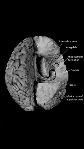 "Medial Temporal Lobe Structures in Human Brain: Annotated Sagittal Dissection"