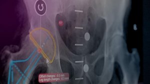 Orthopedic Templating Software