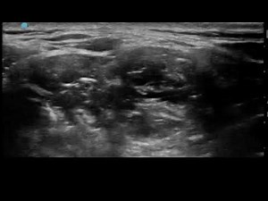 Scalene Injection of Botox for Thoracic Outlet Syndrome-Arun Kalava MD FASA EDRA