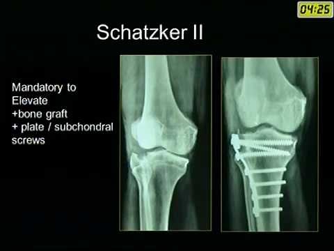Tibial Plateau Fractures