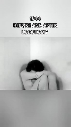 Lobotomy Before and After: Survivor Stories and Results